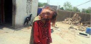 Por qué esta niña vive con la cabeza inclinada a 90 grados desde los ocho meses (FOTOS)