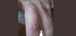 Van tres afectados en un mes por la picadura del mosquito Tábano en Barquisimeto