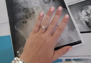 VIRAL: ¡Insólito! Una mujer tragó su anillo de compromiso en medio de un sueño