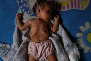 ONU pide “acciones urgentes” contra la desnutrición infantil en 15 países