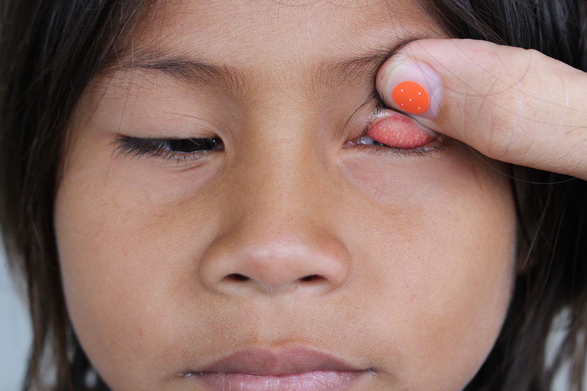 OPS busca casos tracoma en las comunidades indígenas a orillas del río Orinoco