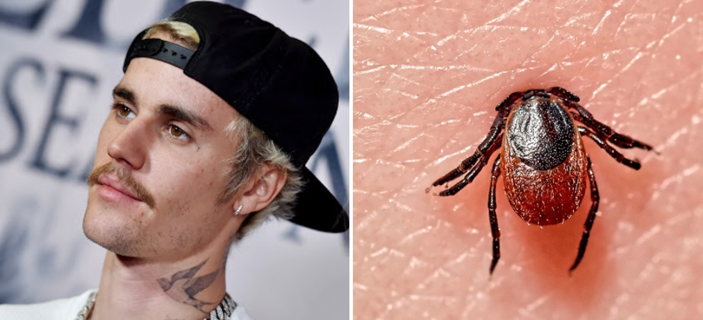 Enfermedad de Lyme: De qué se trata el raro padecimiento que afecta a Justin Bieber