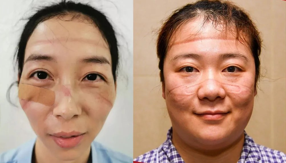 Bajo de las mascarillas: Los rostros marcados de médicos que combaten el coronavirus (FOTOS)