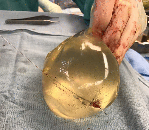 Implantes mamarios le salvaron la vida al desviar una bala que iba a su corazón (FOTOS)