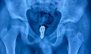Fue al médico por dolores de vejiga y descubren 20 bolitas magnéticas dentro de su miembro viril