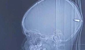 Médicos encuentran una bala en el cerebro de un niño israelí que solo estaba “somnoliento”