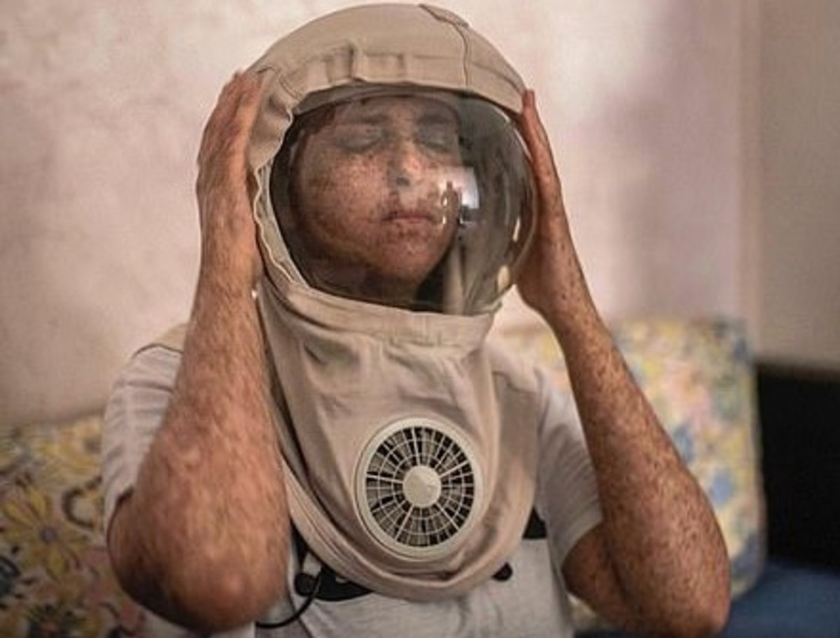 La triste historia de la mujer alérgica al Sol: Vive de noche y usa un casco de astronauta