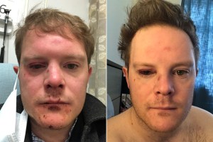 Actor de Broadway fue brutalmente golpeado en la cara por un mendigo en el Metro de Nueva York