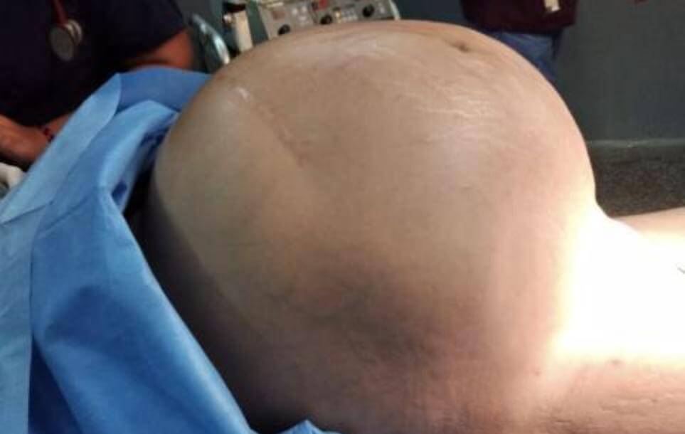 Extraen tumor de ocho kilos a una mujer en el Zulia (Imágenes sensibles)