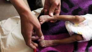 Casos de desnutrición aguda en Guatemala crecieron en un 80%
