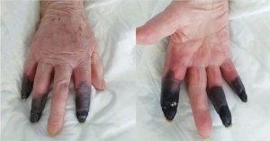 Desconcierto en Italia: Le amputaron tres dedos tras desarrollar inesperada gangrena por el Covid-19
