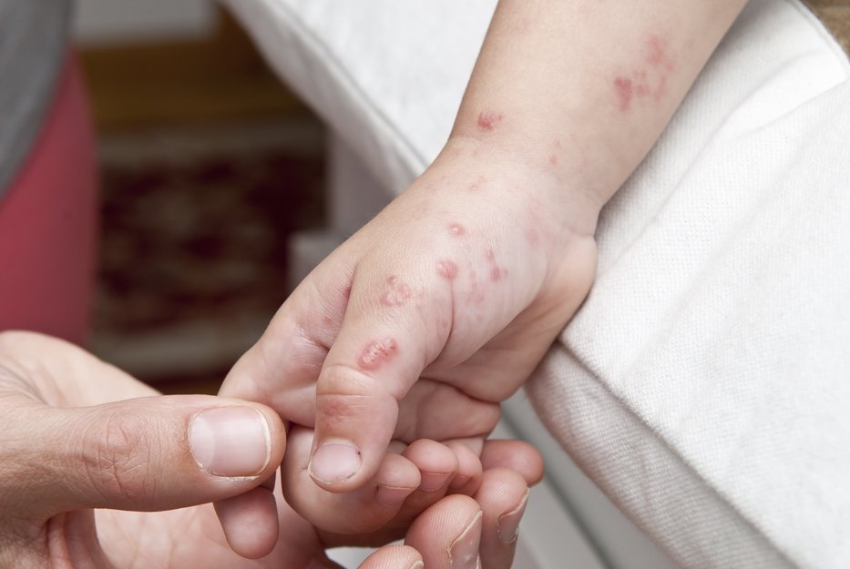 Reportan casos de 105 niños con síntomas de sarampión en el Caura