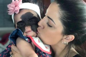 Nació con la “máscara de Batman”: Niña estadounidense obligada a suspender su tratamiento en Rusia