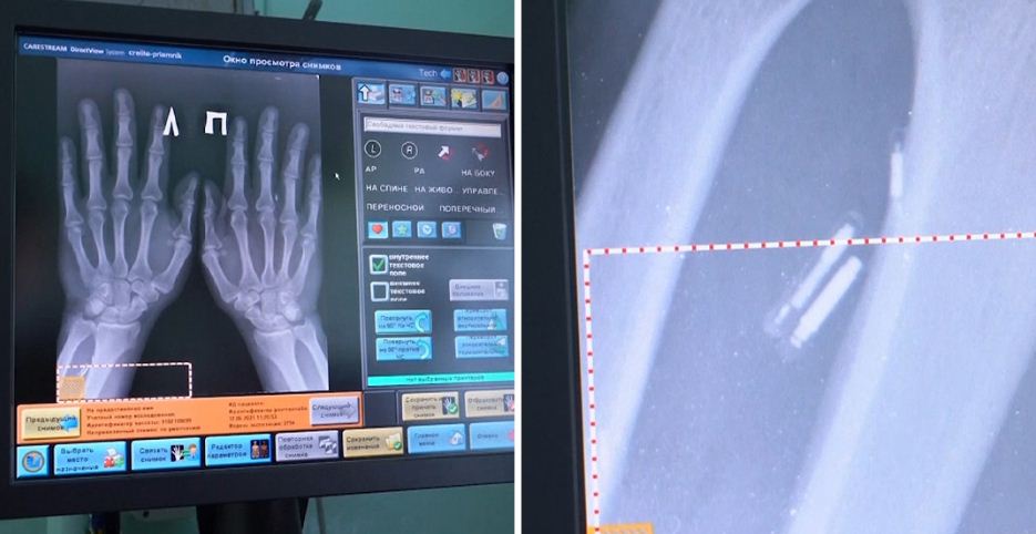 Médico ruso se implantó cinco microchips en las manos para hacer su vida “más fácil” (video)