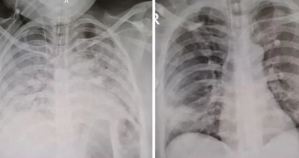 Impacto del Covid-19: ¿Cómo se ven los pulmones de un paciente vacunado y otro sin vacunar?