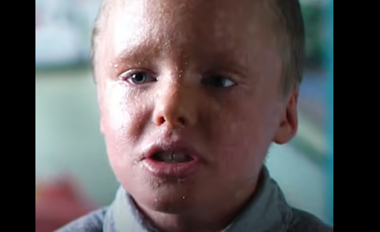 “Me llaman tomate rojo”: La extraña enfermedad en la piel de un niño en Rusia (Video)