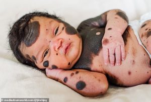 Manchas por doquier: Una bebé de EEUU con extraña condición en la piel inspira a millones en Instagram