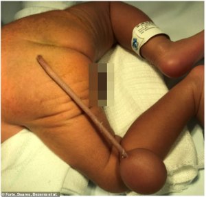 El extraño caso del niño que nació en Brasil con una cola de 12 centímetros (FOTOS)