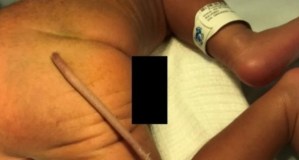 El extraño caso de un bebé que nació con una cola de 12 centímetros