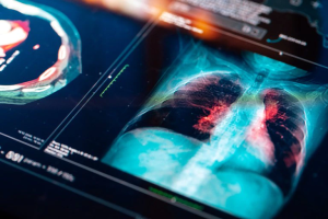 El 70% de los casos de cáncer de pulmón se detectan en etapa avanzada: cuáles son los síntomas y cuándo consultar