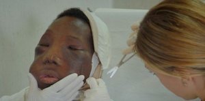 Joven con extraño tumor que desfiguró su rostro encontró la cura y su cambio asombra a todos (Fotos)