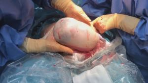 Impresionante momento en el que nace gemela por cesárea con el saco amniótico aún intacto (Imágenes)