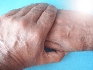 El Parkinson se duplicará en los próximos años por el envejecimiento de la población