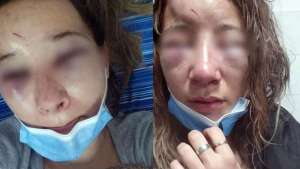 Atacaron ferozmente a una joven saliendo de una discoteca argentina: la desfiguraron y le arrancaron las uñas