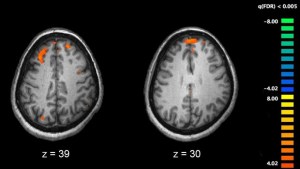 Revelaron las causas de la esquizofrenia: la genética tiene mucho que ver