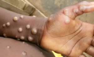 La EMA asegura que la viruela del mono no es “una emergencia de salud pública”