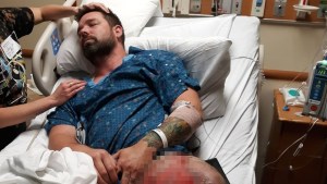 Hombre de Florida quedó con graves quemaduras tras estallarle un vaper en su bolsillo