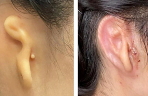 Cirujano implantó en paciente una oreja impresa a partir de células humanas