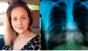 Increíble: Mujer rusa tiene sus órganos ubicados al revés