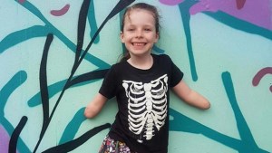 La lamentable historia de Mia Wikinson, la niña que enfermó con una simple gripe y terminó perdiendo sus extremidades