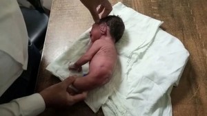 Nació con un cuerno en lugar de piernas: el caso del bebé que dejó atónitos a los médicos (FOTOS)