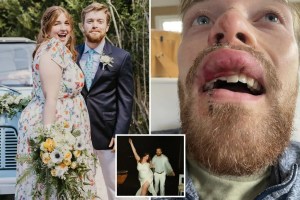 ¡Ouch! El desafortunado incidente que le costó el diente a un novio un día antes de su boda en EEUU