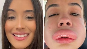 Se puso relleno en los labios y tuvo una reacción que le dejó la cara deformada (VIDEO)