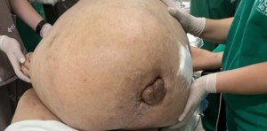 “Milagro”: Mide 1,50 y vivió cinco años con un tumor de 46 kilos, como un hipopótamo bebé