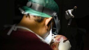 La moda de los trasplantes capilares esconde mortales peligros en India
