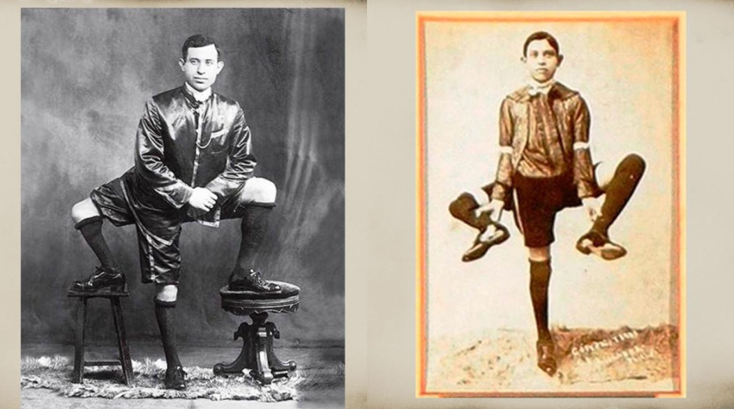 La historia de Frank Lentini, el hombre con tres piernas, dos penes y cuatro testículos