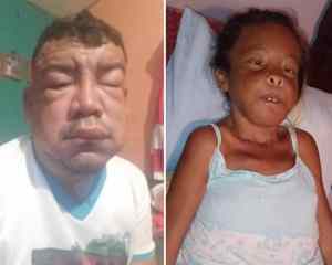 Pacientes renales de Sabaneta de Barinas, sin combustible para asistir a las diálisis