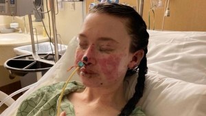 Drama en Utah: La piel de una mujer “se quema desde adentro” y la razón causó impacto
