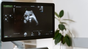 VIDEO: El perturbador rostro de un bebé revelado en un ultrasonido que se hizo VIRAL