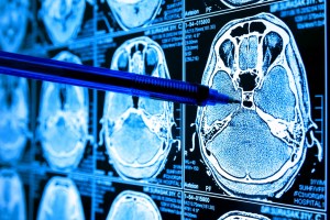 Avances tecnológicos: herramienta de IA logra analizar el ADN del cáncer cerebral durante una operación