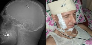 Se hizo una cirugía cerebral a sí mismo para implantarse un electrodo y “controlar los sueños”