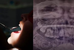 La insólita historia del niño que tenía más de 500 dientes: la mandíbula le pesaba bastante
