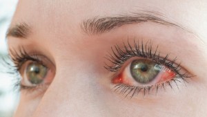 Turista estadounidense adquirió una extraña enfermedad que la hizo sangrar por los ojos
