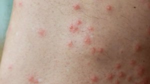 El aumento de las infecciones por parásitos que desfiguran la piel que se extienden por EEUU