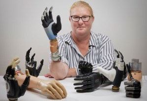 Una mano biónica conectada a los nervios y los huesos funciona tras 20 años de uso diario