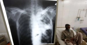 Cifra de casos de tuberculosis asciende en Margarita
